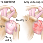Viêm khớp: Nguyên nhân, triệu chứng, chẩn đoán và điều trị